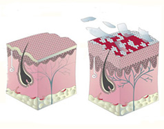 Factor de Transferencia Psoriasis